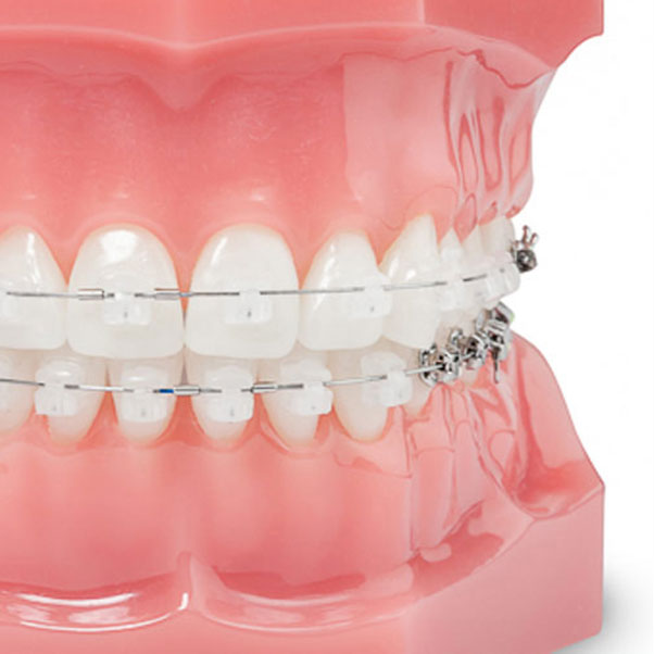 Das Damon ® -System ist eine feste sichtbare Zahnspange
